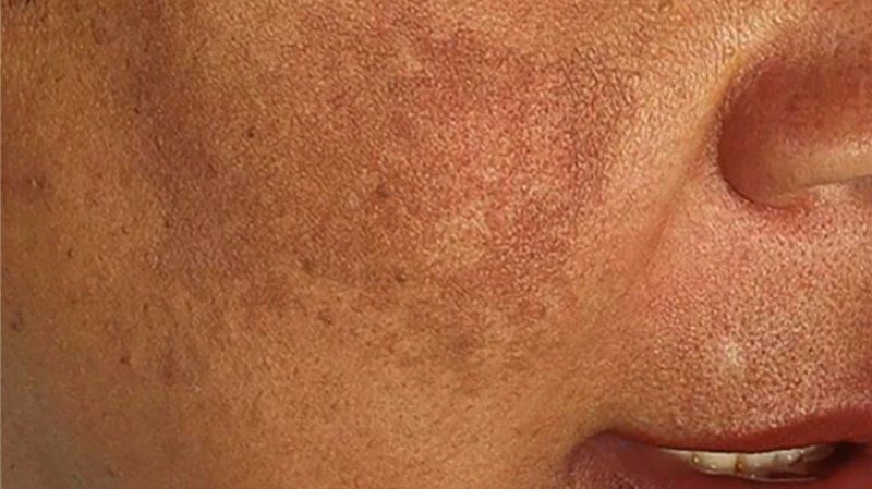 hiperpigmentasi pasca inflamasi